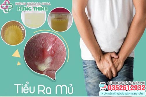 Đi Tiểu Ra Máu: Nguyên Nhân, Dấu Hiệu Nhận Biết và Phương Pháp Điều Trị