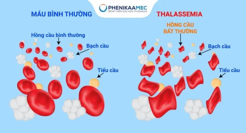 Biểu Hiện Trẻ Thiếu Sắt: Dấu Hiệu Nhận Biết Sớm Và Cách Xử Lý