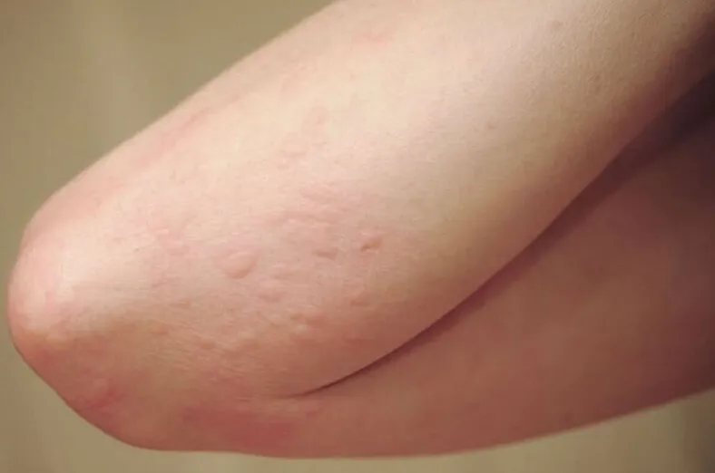 Cảnh báo tác dụng phụ khi ăn chanh dây quá nhiều