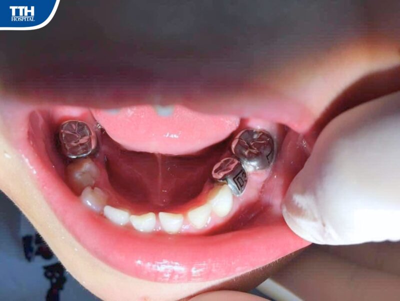 Chụp Thép Răng Trẻ Em: Giải Pháp Bảo Vệ Toàn Diện Cho Hàm Răng Sữa