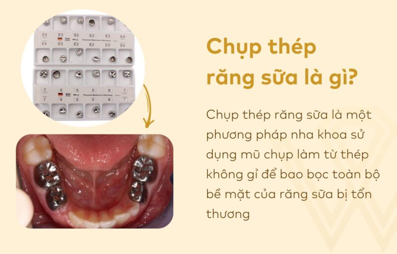 Chụp Thép Răng Trẻ Em: Giải Pháp Bảo Vệ Toàn Diện Cho Hàm Răng Sữa