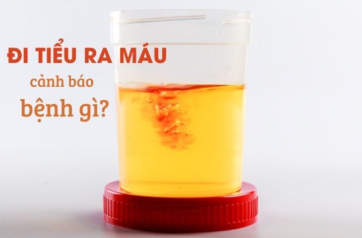 Chẩn Đoán Và Điều Trị Đi Tiểu Ra Máu (Đái Máu)