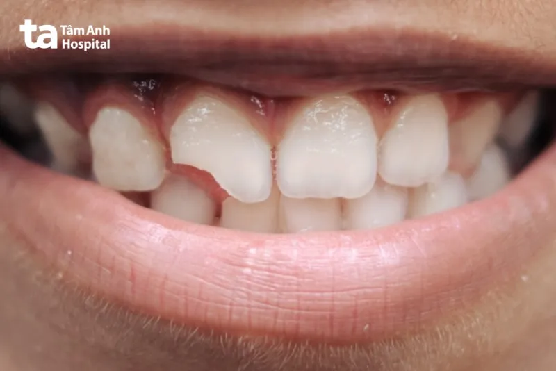 TrÆ°á»ng há»£p nÃ o cÃ³ thá»ƒ hÃ n rÄƒng báº±ng GIC?