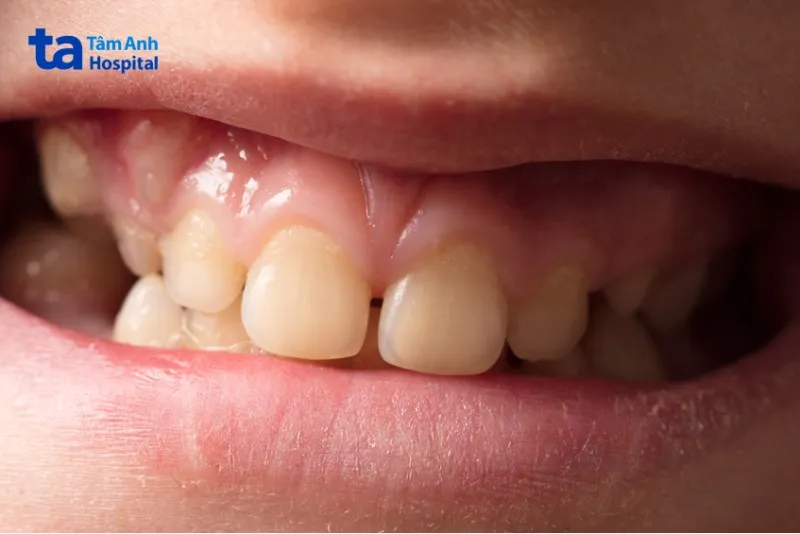 trÃ¡m rÄƒng báº±ng GIC